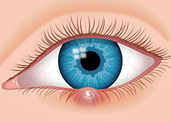 Stye In Your Eye: Types and Treatment
