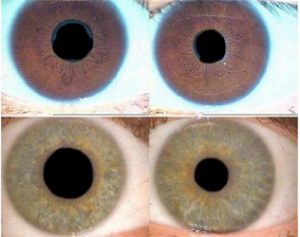 Eye and Pupil PERRLA Assessment